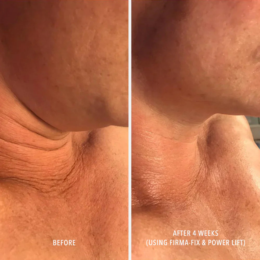Before and after comparison of neck skin texture using Firma-Fix and Power Lift treatment.