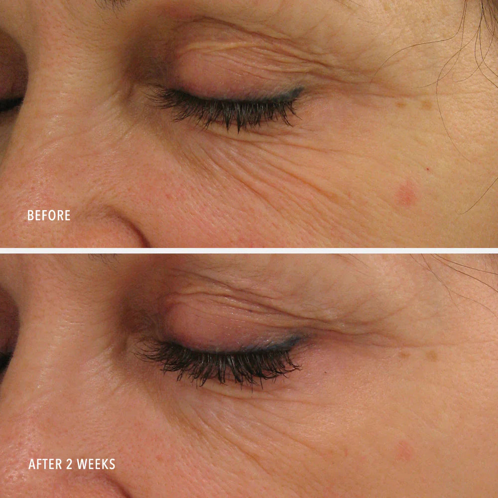 Before and after comparison of a person's eye area with visible changes over two weeks.