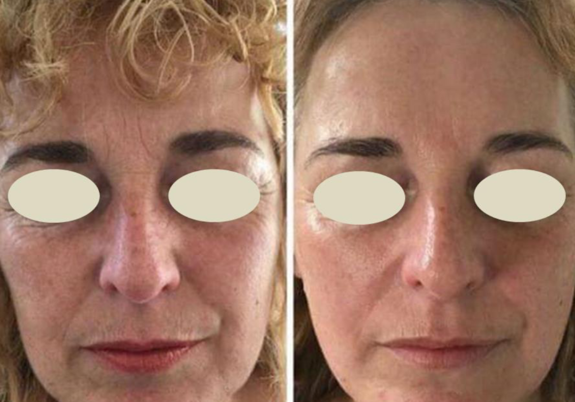 TRSA RF Lift at Tina Roche Skin & Aesthetics