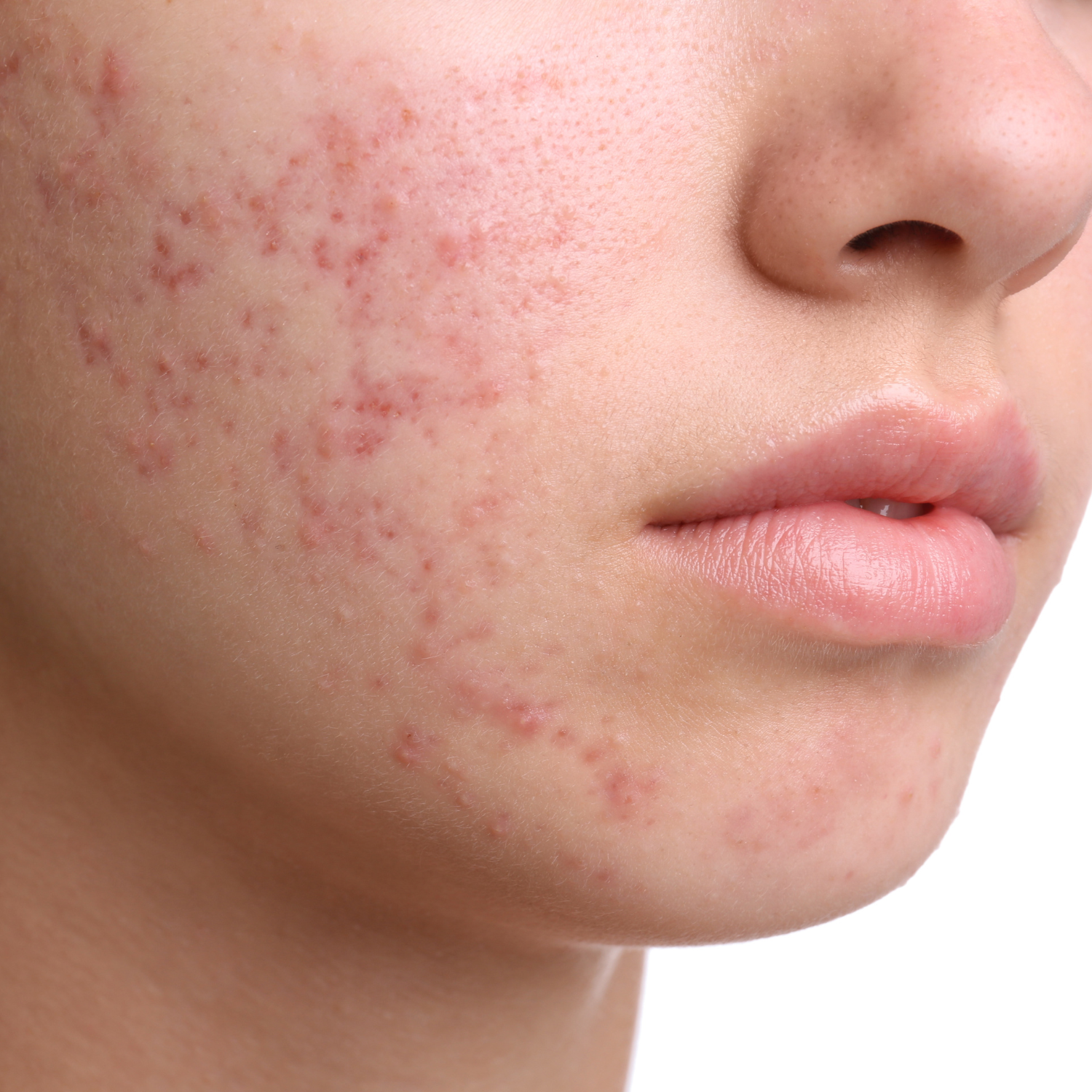 Ache before treatment