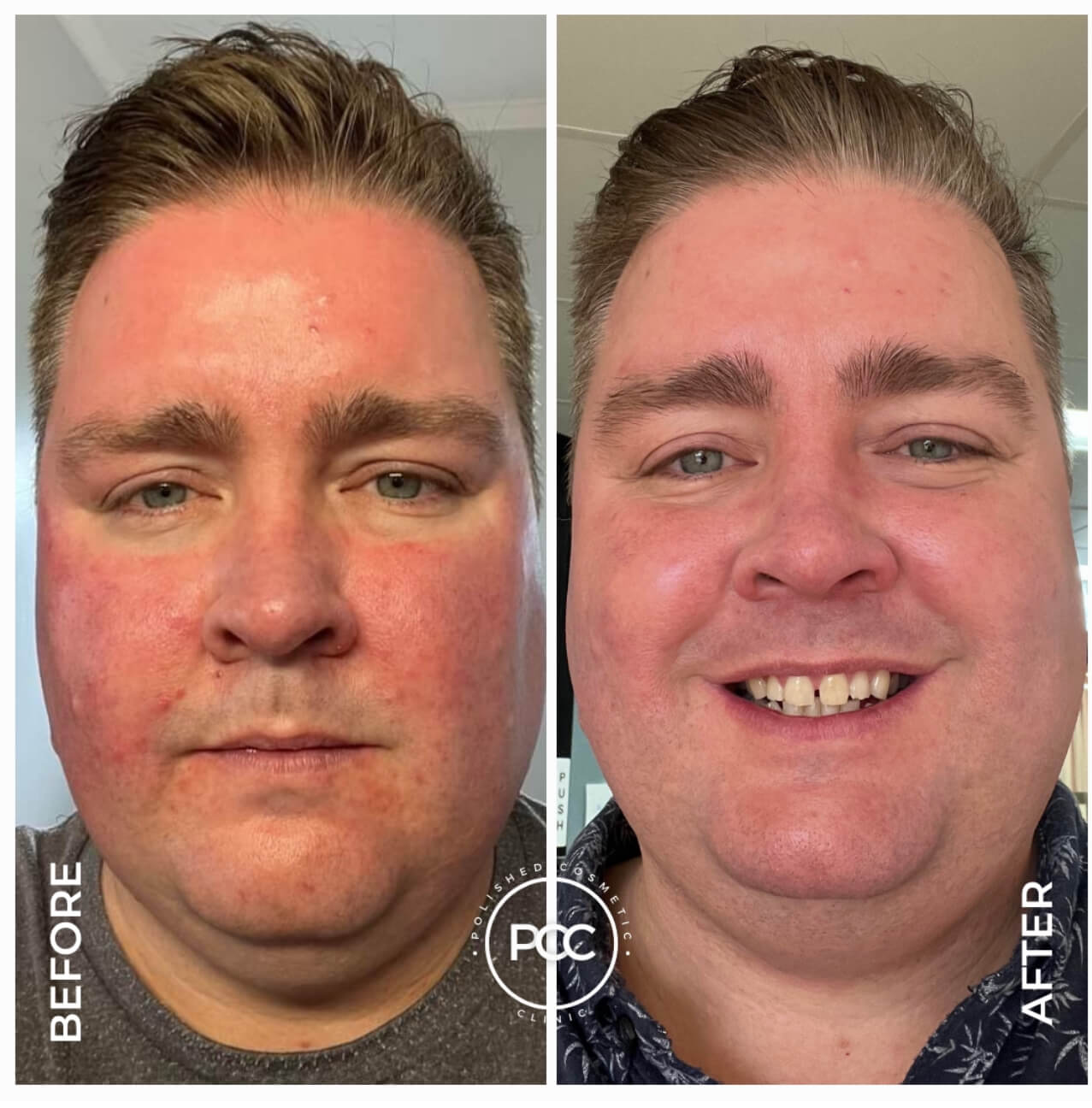 Redness skincare treatment