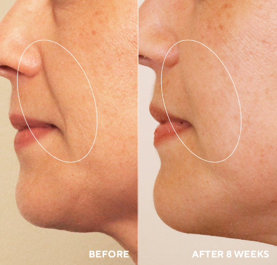 Before and after comparison of a person's face with a focus on the nose area, showing skin texture improvement over 8 weeks.