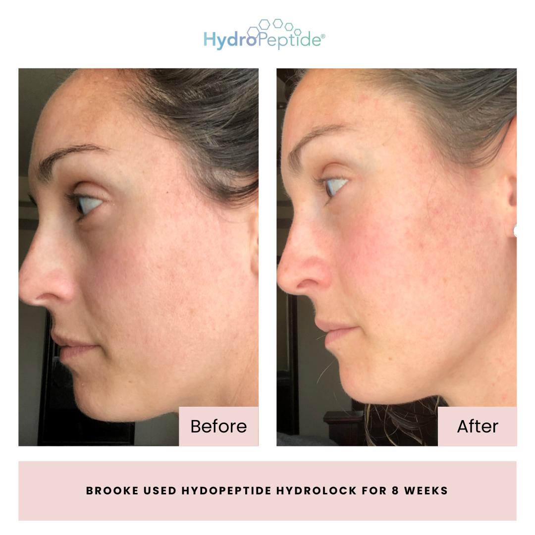 Before and after comparison of a woman's face using Hydropeptide Hydrolock, with the brand name displayed.