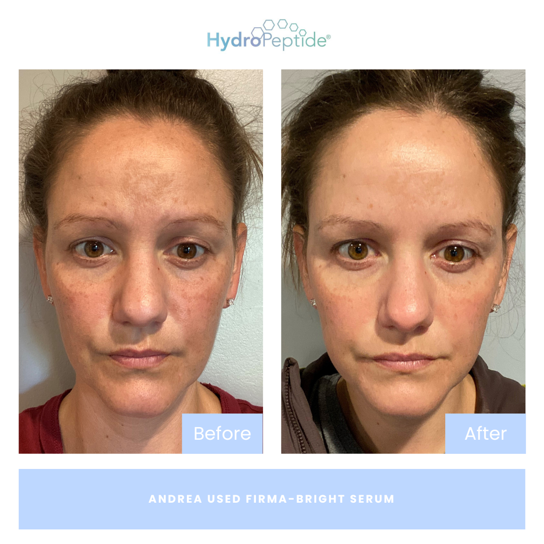 Before and after comparison of a woman's face with HydroPeptide serum, showing visible skin improvement.