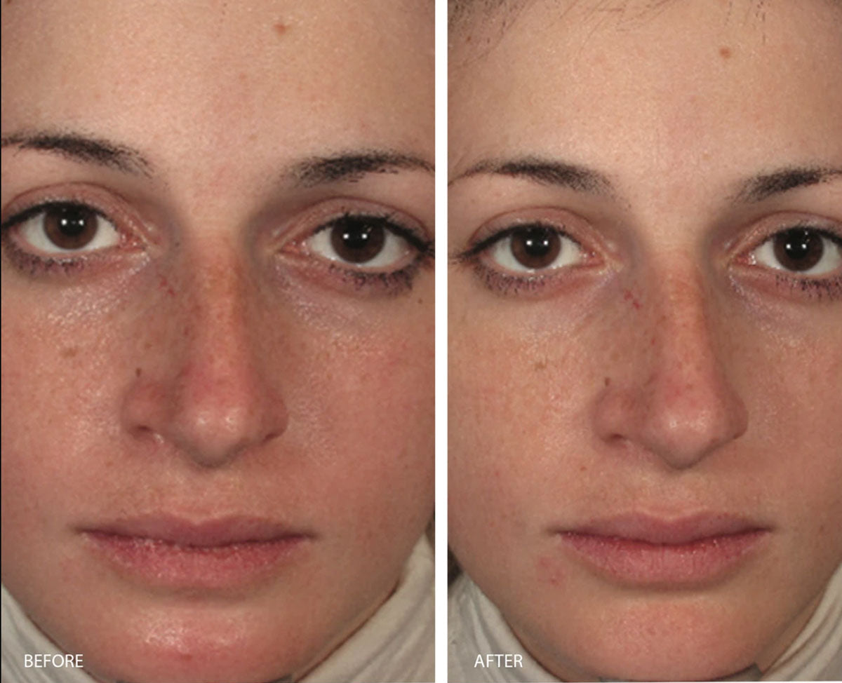 Redness skincare treatment