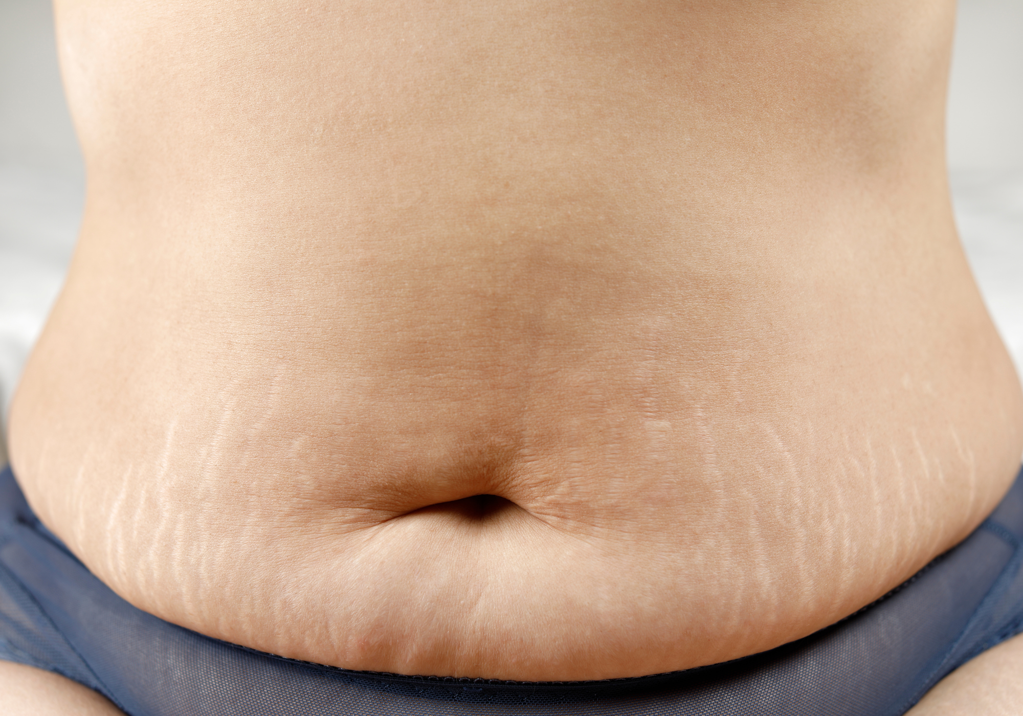 Reduce stretch marks