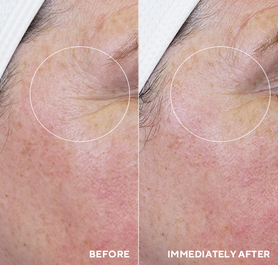 Before and after comparison of skin texture on a person's forehead.