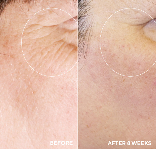 Before and after comparison of skin texture on a person's face, showing improvement after 8 weeks.