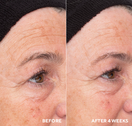 Before and after comparison of a person's eye area with visible skin texture changes over 4 weeks.