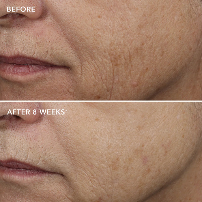 Before and after comparison of skin texture on a person's face, showing improvement after 8 weeks.