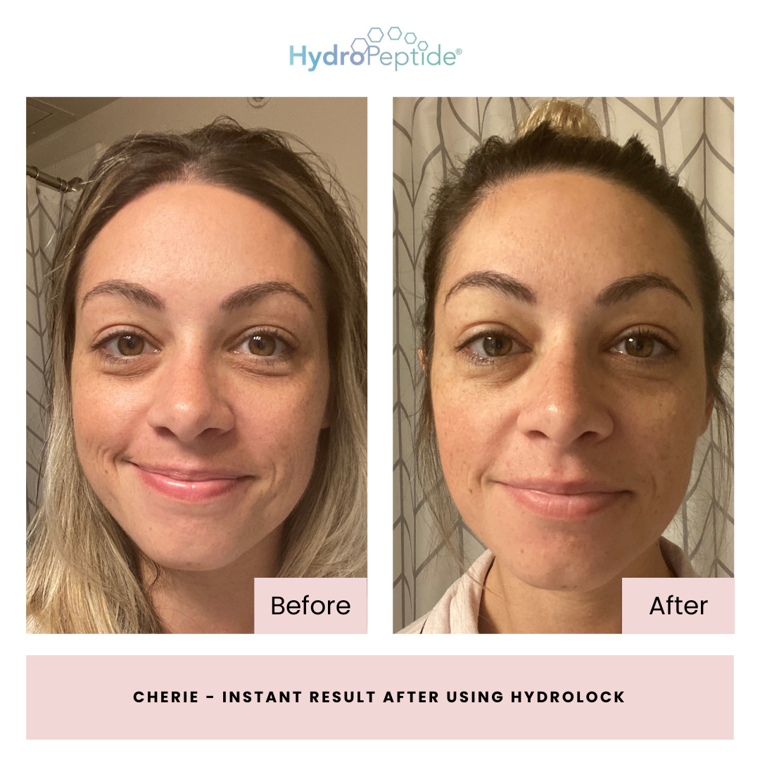 Before and after comparison of a woman's face using Hydropeptide HydroLock, with 'Before' on the left and 'After' on the right.