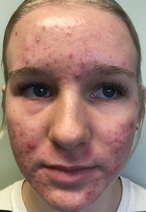 Person with acne on their face against a plain background