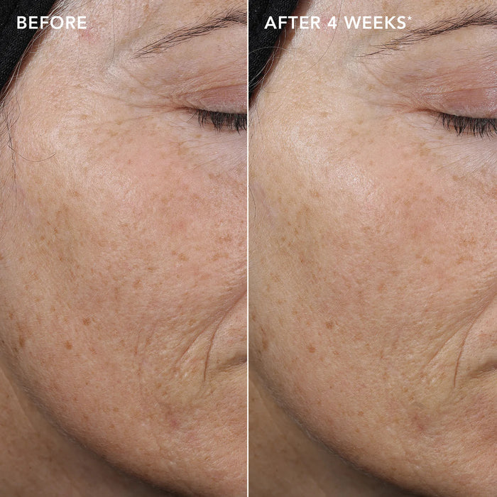 Before and after comparison of skin texture on a person's face, showing improvement over 4 weeks.