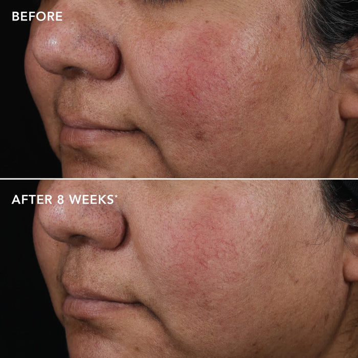 Before and after comparison of a person's face with visible skin conditions, showing improvement over 8 weeks.