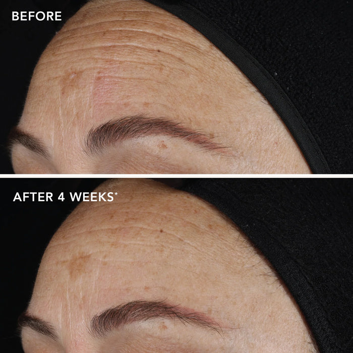 Before and after comparison of a person's forehead with visible wrinkles, labeled 'After 4 Weeks'.