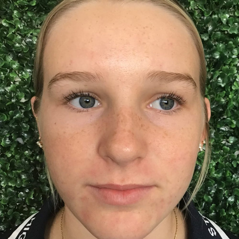 After: clear skin with no active breakouts