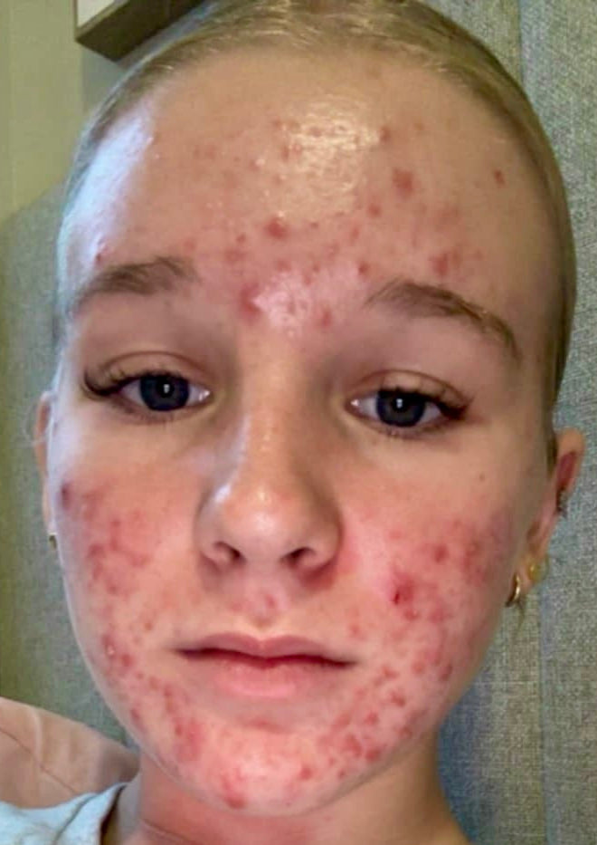Before: inflammatory acne with redness on cheeks