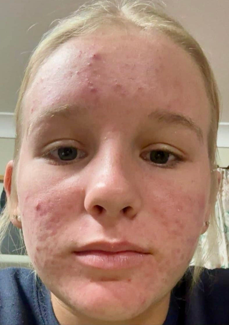 After 12 weeks: reduced breakouts and redness; smoother texture