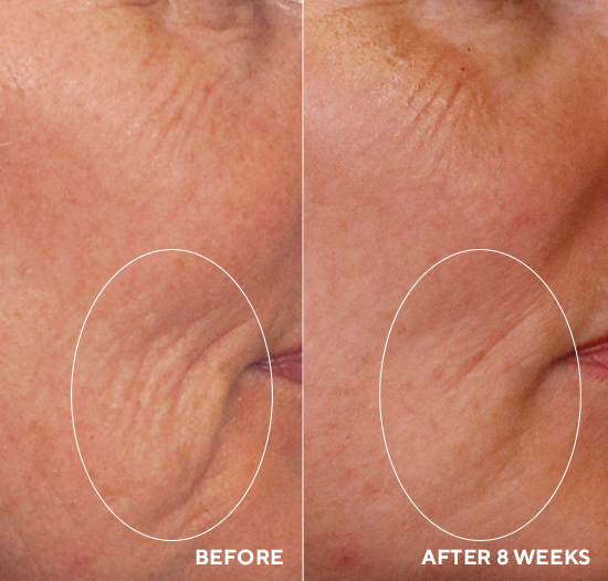 Before and after comparison of skin texture around the eye area with visible improvement after 8 weeks.