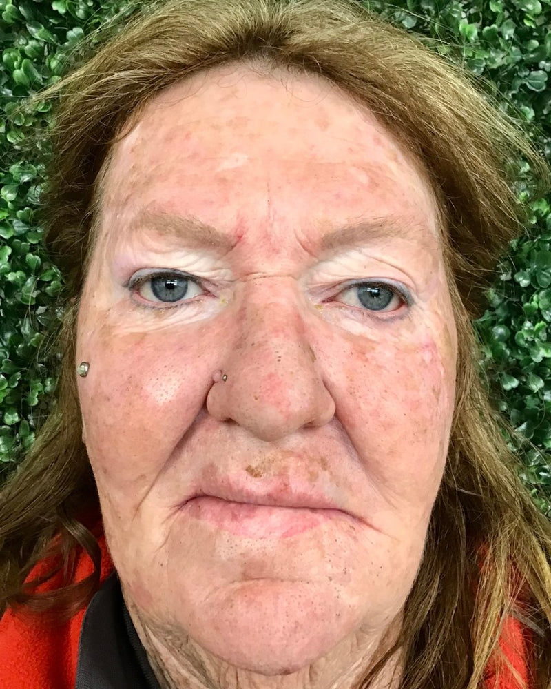 Before: sun damage, redness and uneven tone